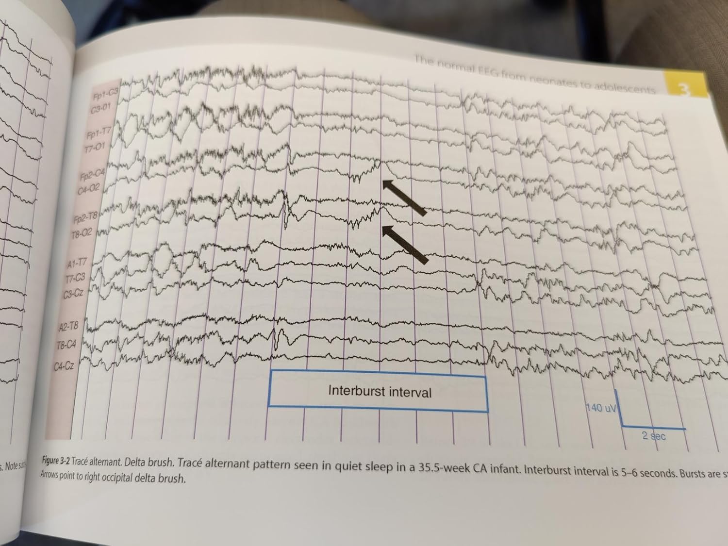 Rowan's Primer of EEG 2nd Edition 9780323353878 - Image 2