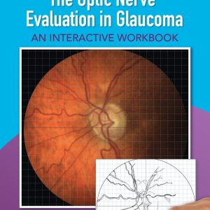 The Optic Nerve Evaluation in Glaucoma: An Interactive Workbook