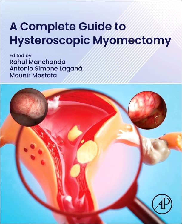 A Complete Guide to Hysteroscopic Myomectomy