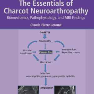 The Essentials of Charcot Neuroarthropathy: Biomechanics