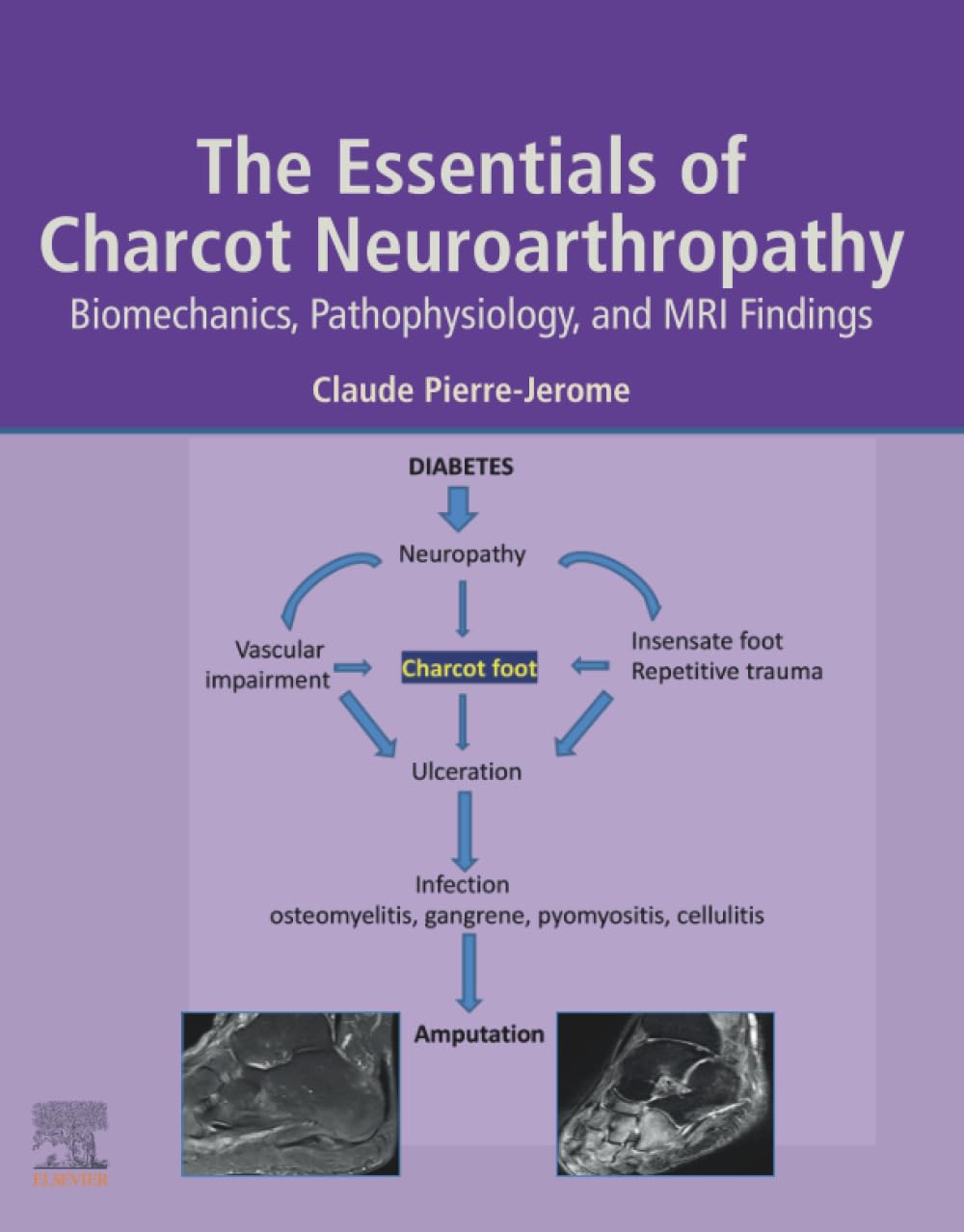 The Essentials of Charcot Neuroarthropathy: Biomechanics