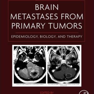 Brain Metastases from Primary Tumors Volume 1: Epidemiology