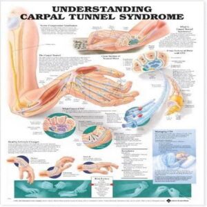 Understanding Carpal Tunnel Syndrome Anatomical Chart-ISBN: 9781587793226