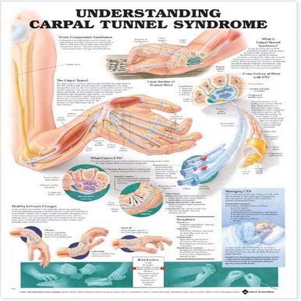 Understanding Carpal Tunnel Syndrome Anatomical Chart-ISBN: 9781587793226