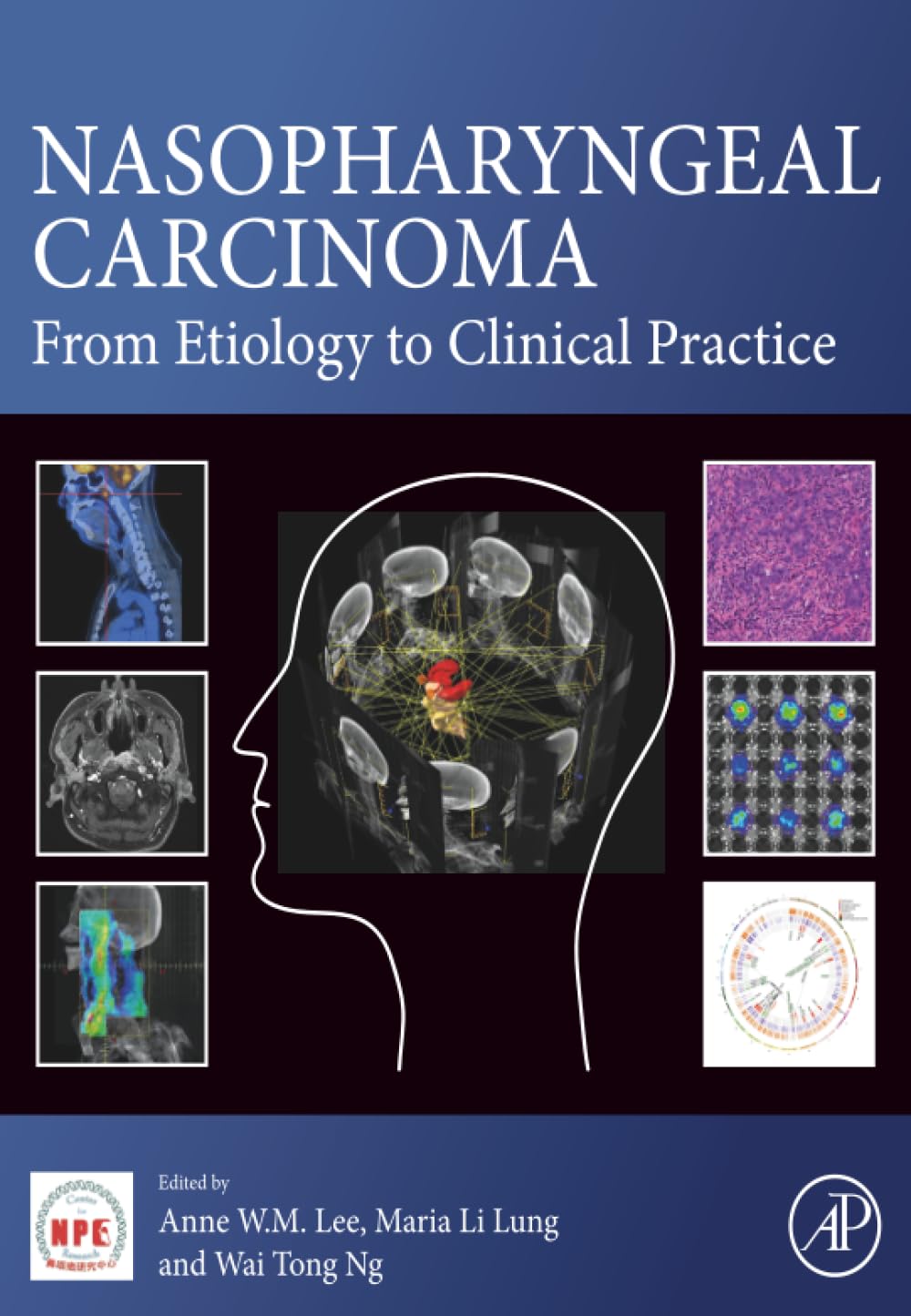 Nasopharyngeal Carcinoma: From Etiology to Clinical Practice