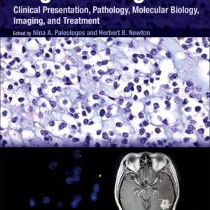 Oligodendroglioma: Clinical Presentation