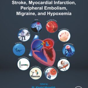 Patent Foramen Ovale Closure for Stroke