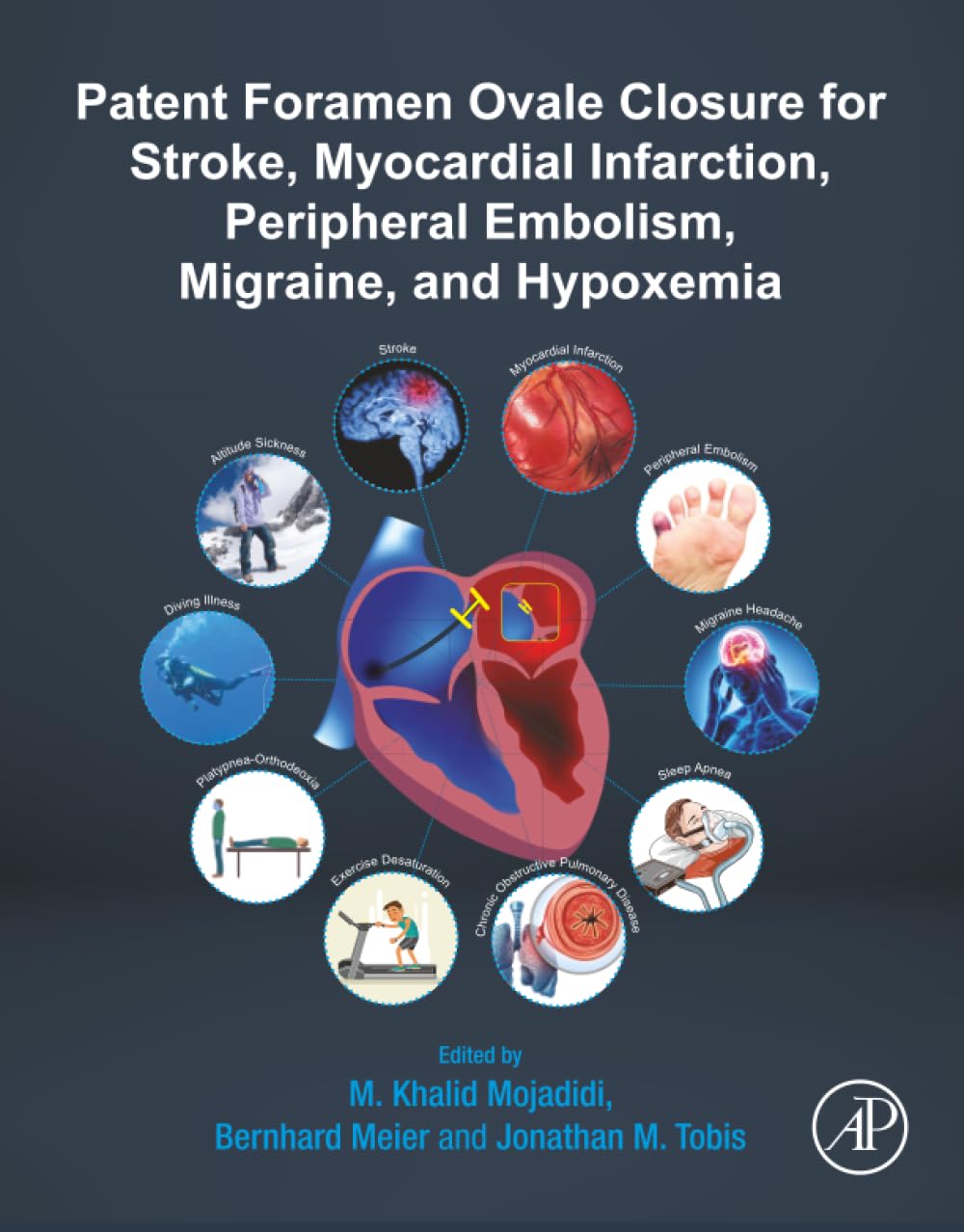 Patent Foramen Ovale Closure for Stroke