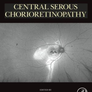 Central Serous Chorioretinopathy