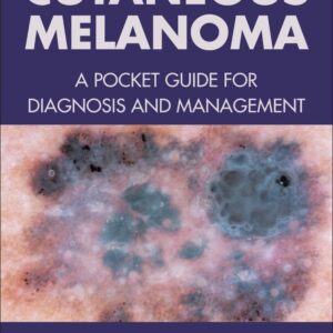 Cutaneous Melanoma: A Pocket Guide for Diagnosis and Management