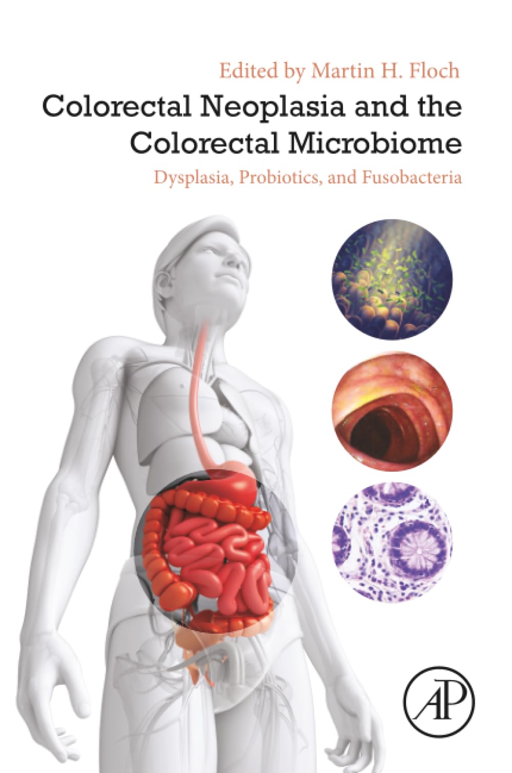 Colorectal Neoplasia and the Colorectal Microbiome: Dysplasia
