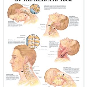 Whiplash Injuries of the Head and Neck Anatomical Chart-ISBN: 9781587793769