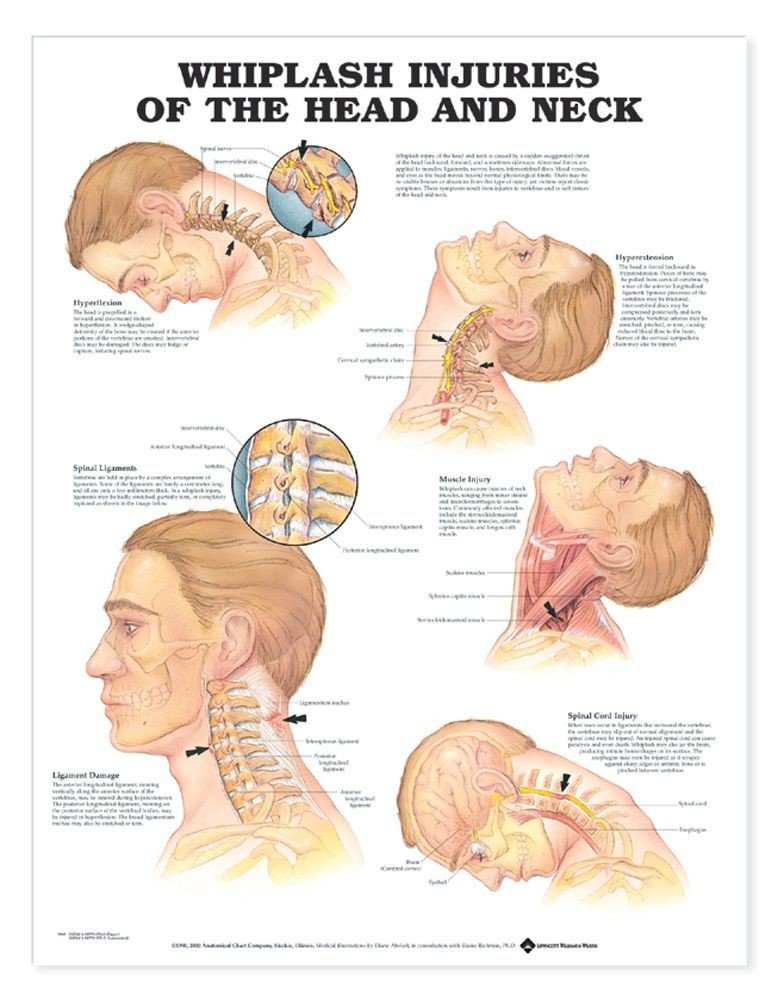 Whiplash Injuries of the Head and Neck Anatomical Chart-ISBN: 9781587793769