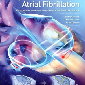 Surgical Treatment of Atrial Fibrillation: A Comprehensive Guide to Performing the Cox Maze IV Procedure