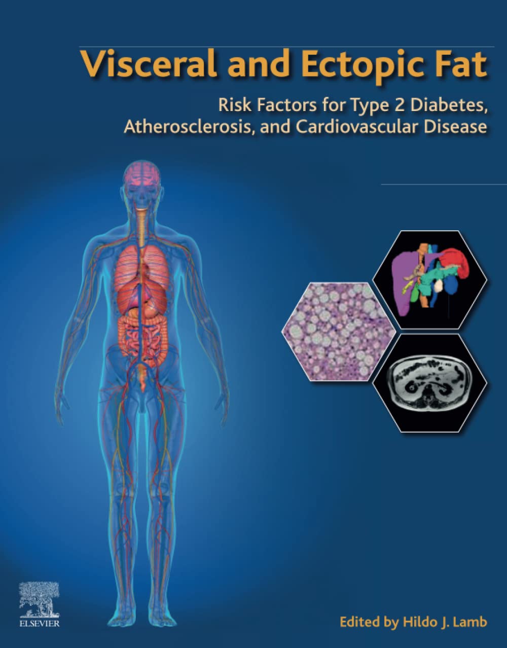 Visceral and Ectopic Fat: Risk Factors for Type 2 Diabetes