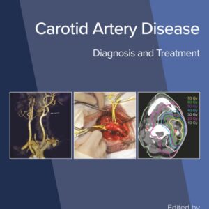 Carotid Artery Disease: Diagnosis and Treatment