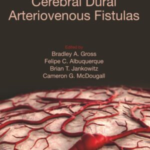 Cerebral Dural Arteriovenous Fistulas