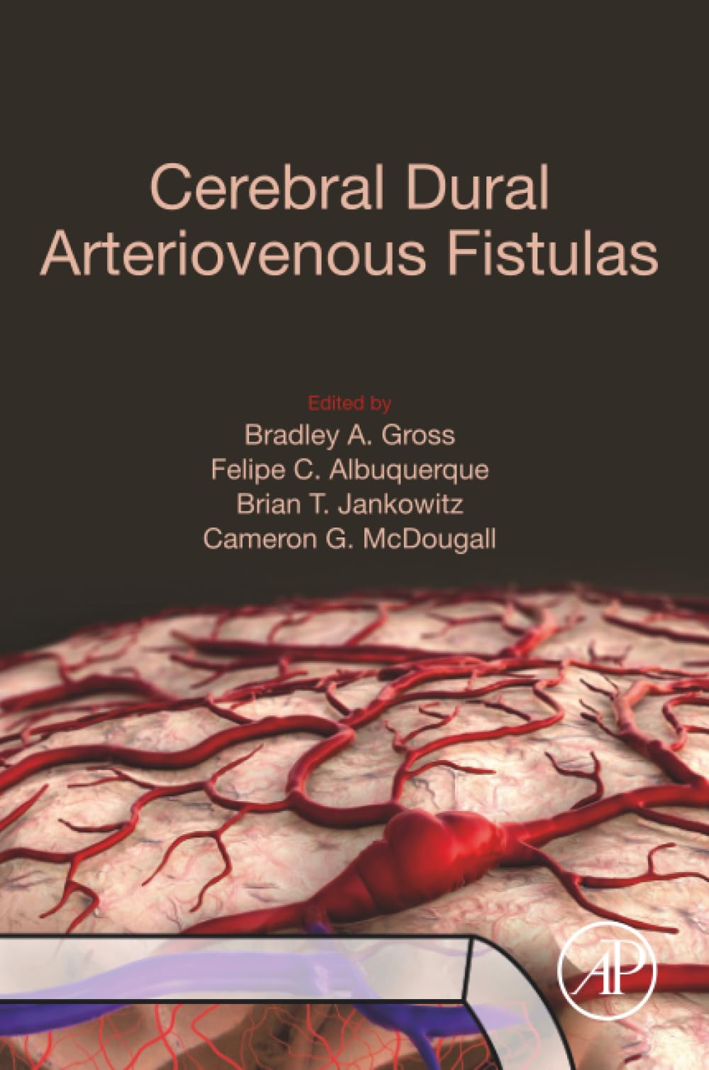 Cerebral Dural Arteriovenous Fistulas