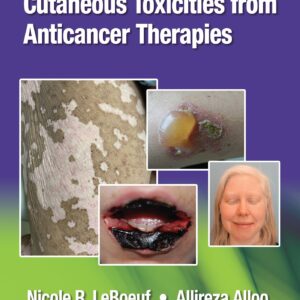 Cutaneous Toxicities from Anticancer Therapies-ISBN: 9781975157890