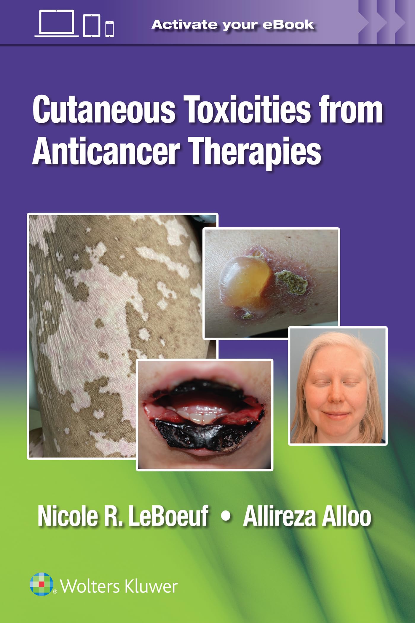 Cutaneous Toxicities from Anticancer Therapies-ISBN: 9781975157890