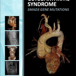 Aneurysms-Osteoarthritis Syndrome: SMAD3 Gene Mutations