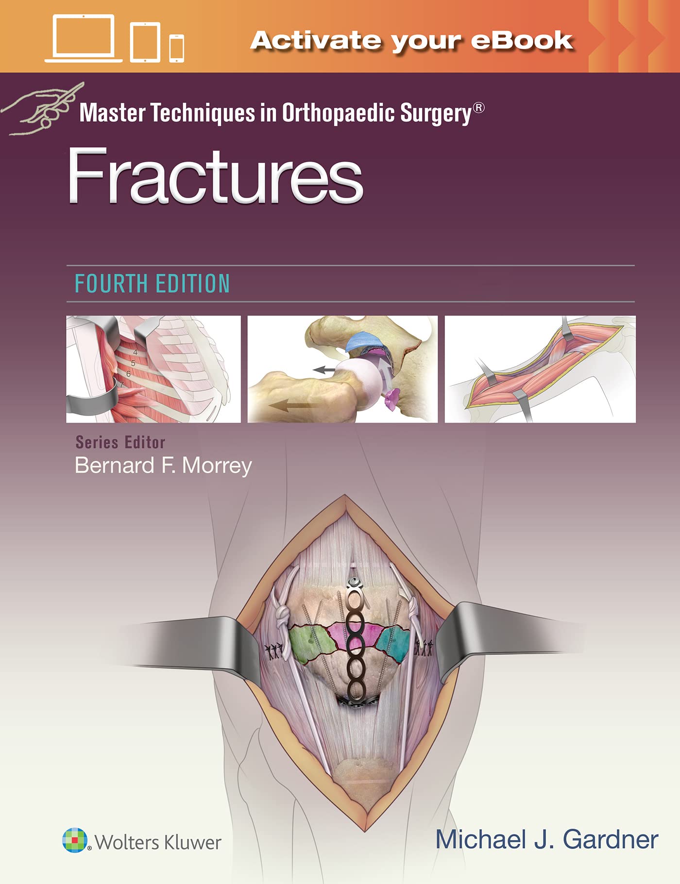 Master Techniques in Orthopaedic Surgery: Fractures-ISBN: 9781975139407