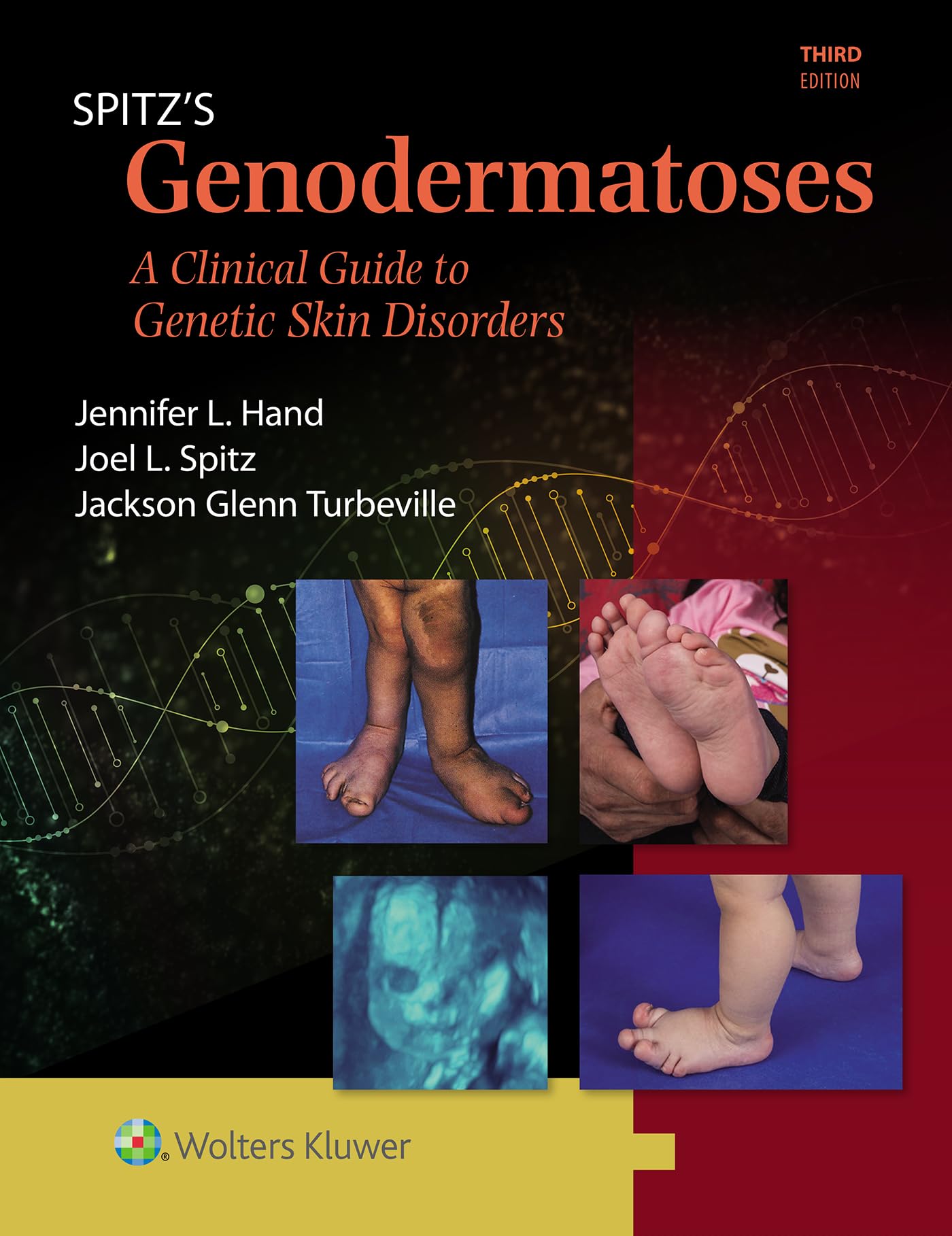 Spitz's Genodermatoses: A Full Color Clinical Guide to Genetic Skin Disorders-ISBN: 9781451116519