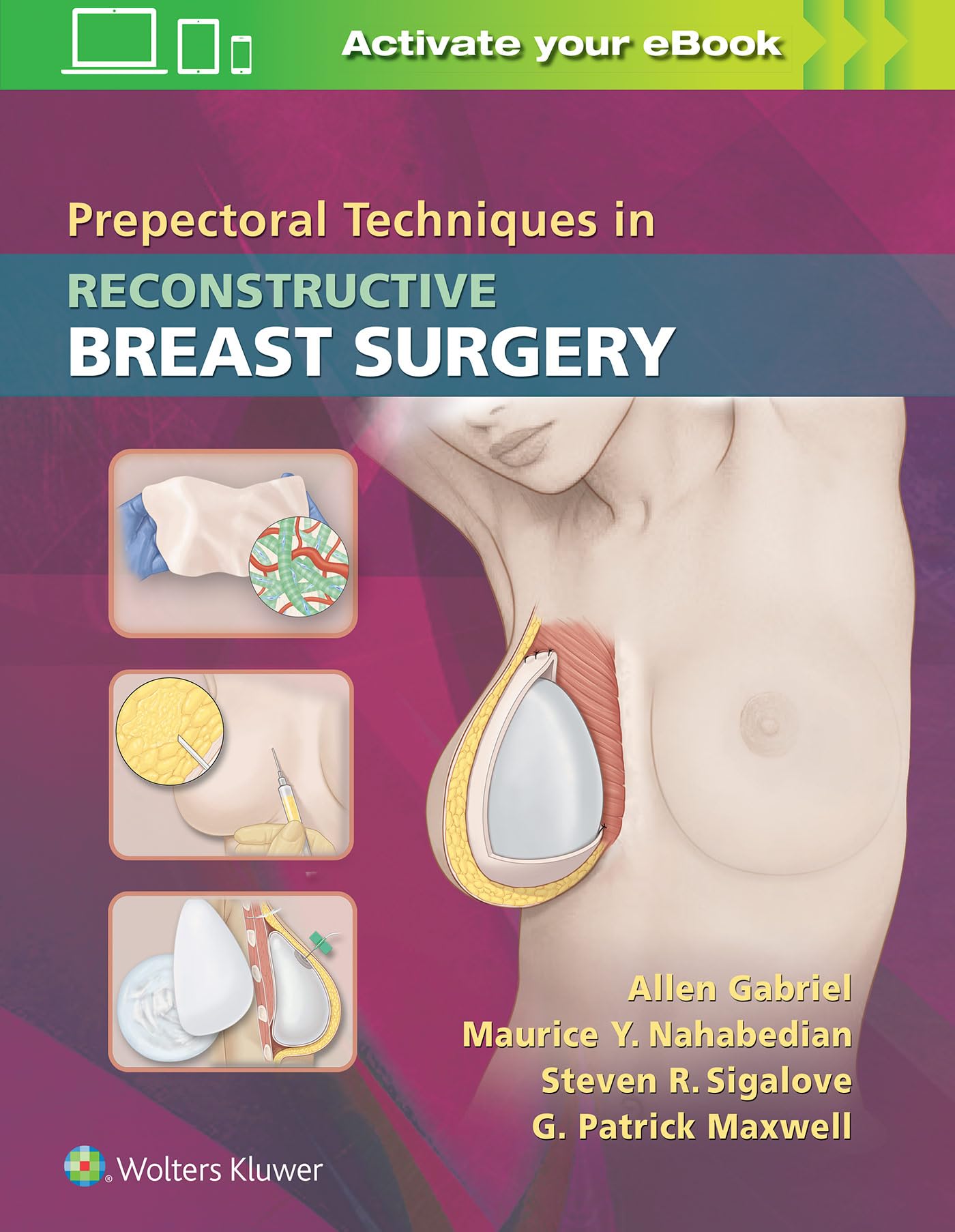 Prepectoral Techniques in Reconstructive Breast Surgery-ISBN: 9781496388278