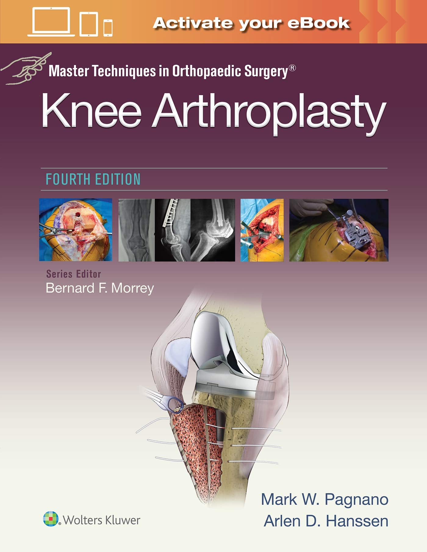 Master Techniques in Orthopedic Surgery: Knee Arthroplasty (Master Techniques in Orthopaedic Surgery)-ISBN: 9781496315052
