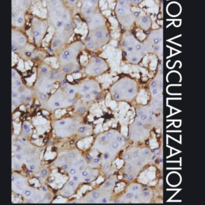 Tumor Vascularization