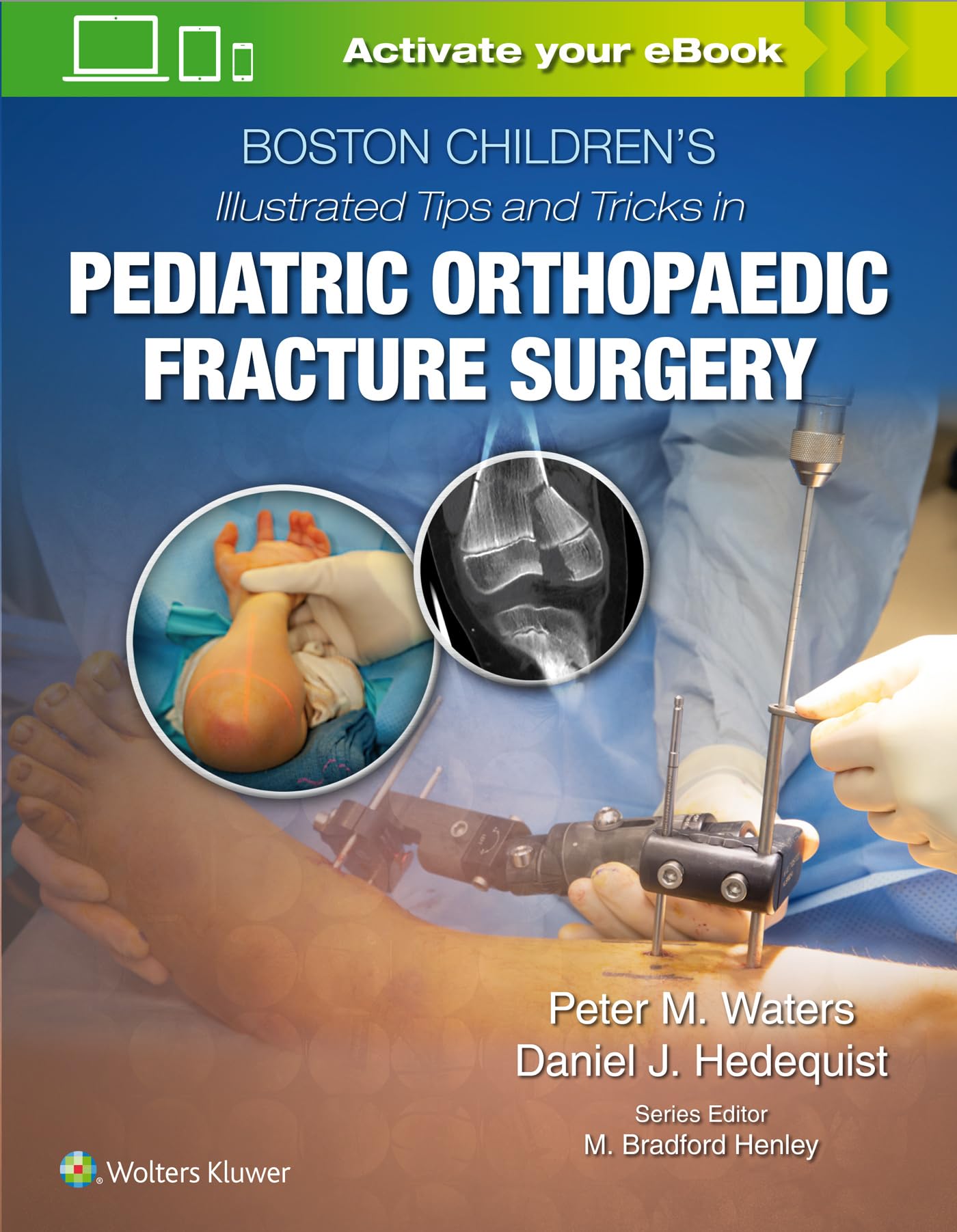 Boston Children’s Illustrated Tips and Tricks in Pediatric Orthopaedic Fracture Surgery-ISBN: 9781975103859