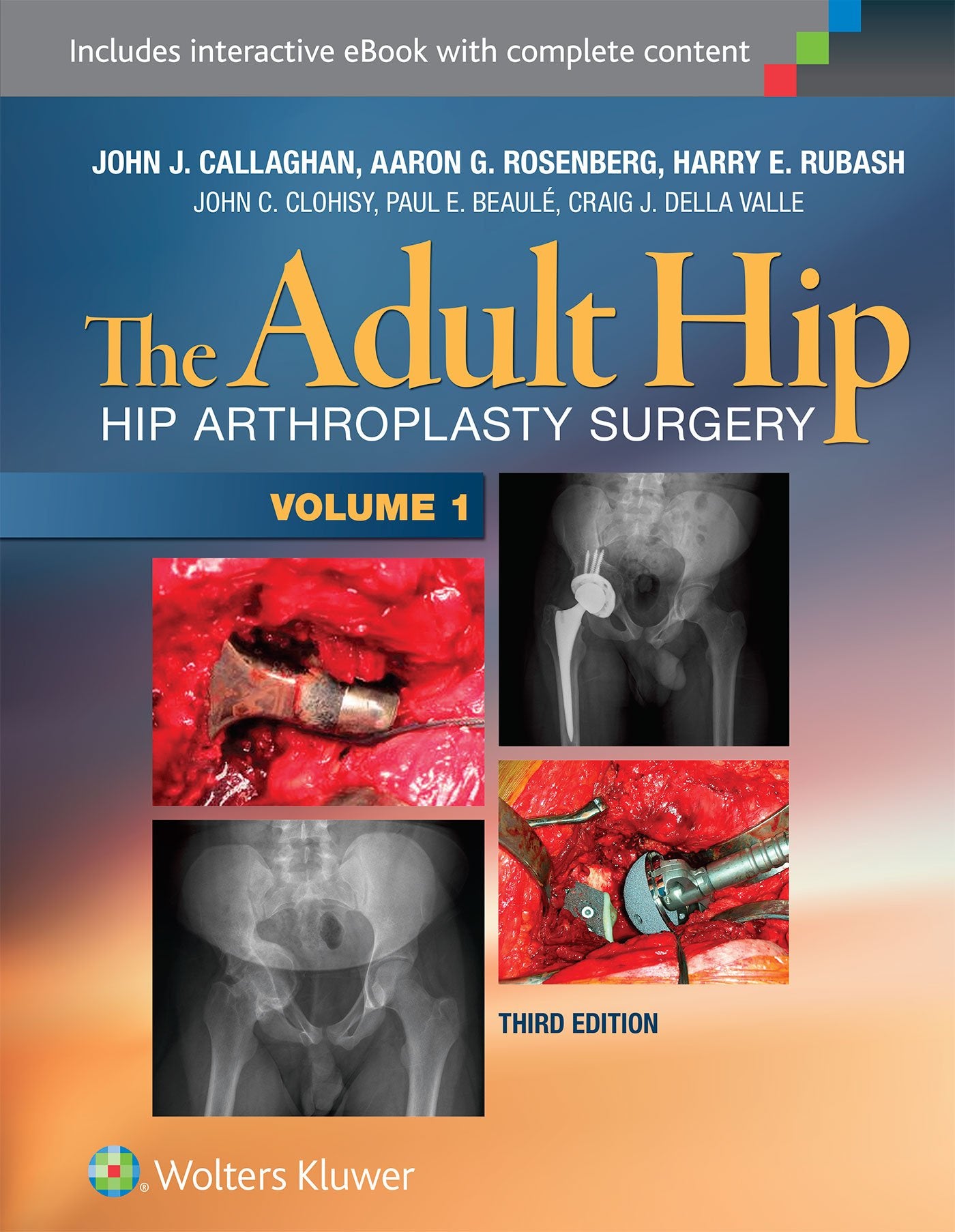 The Adult Hip (Two Volume Set): Hip Arthroplasty Surgery-ISBN: 9781451183696
