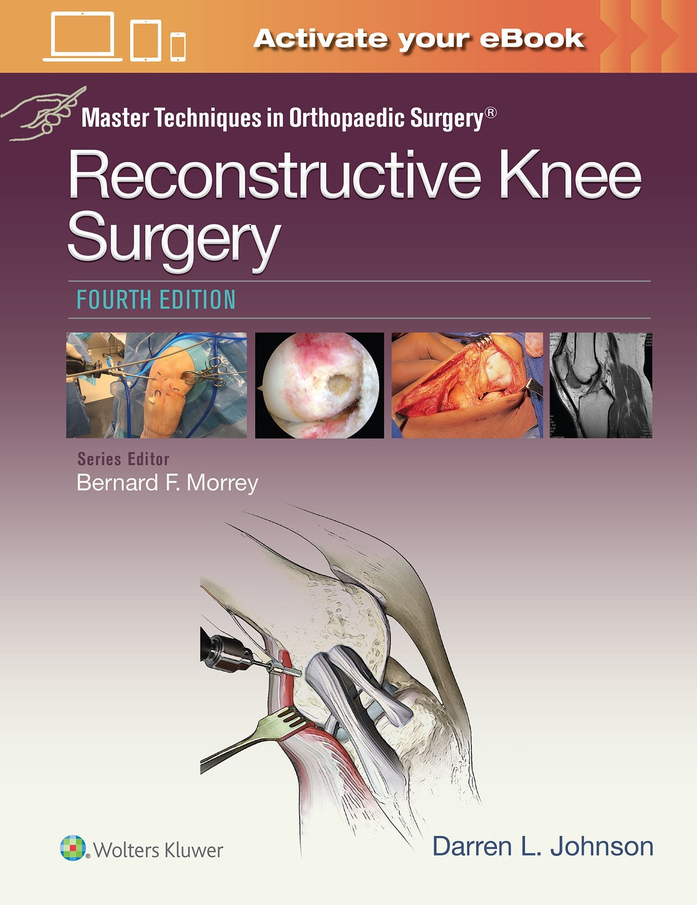 Master Techniques in Orthopaedic Surgery: Reconstructive Knee Surgery-ISBN: 9781496318275