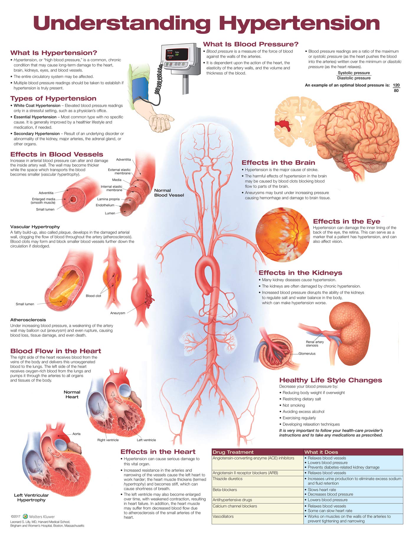 Understanding Hypertension Anatomical Chart-ISBN: 9781496369819