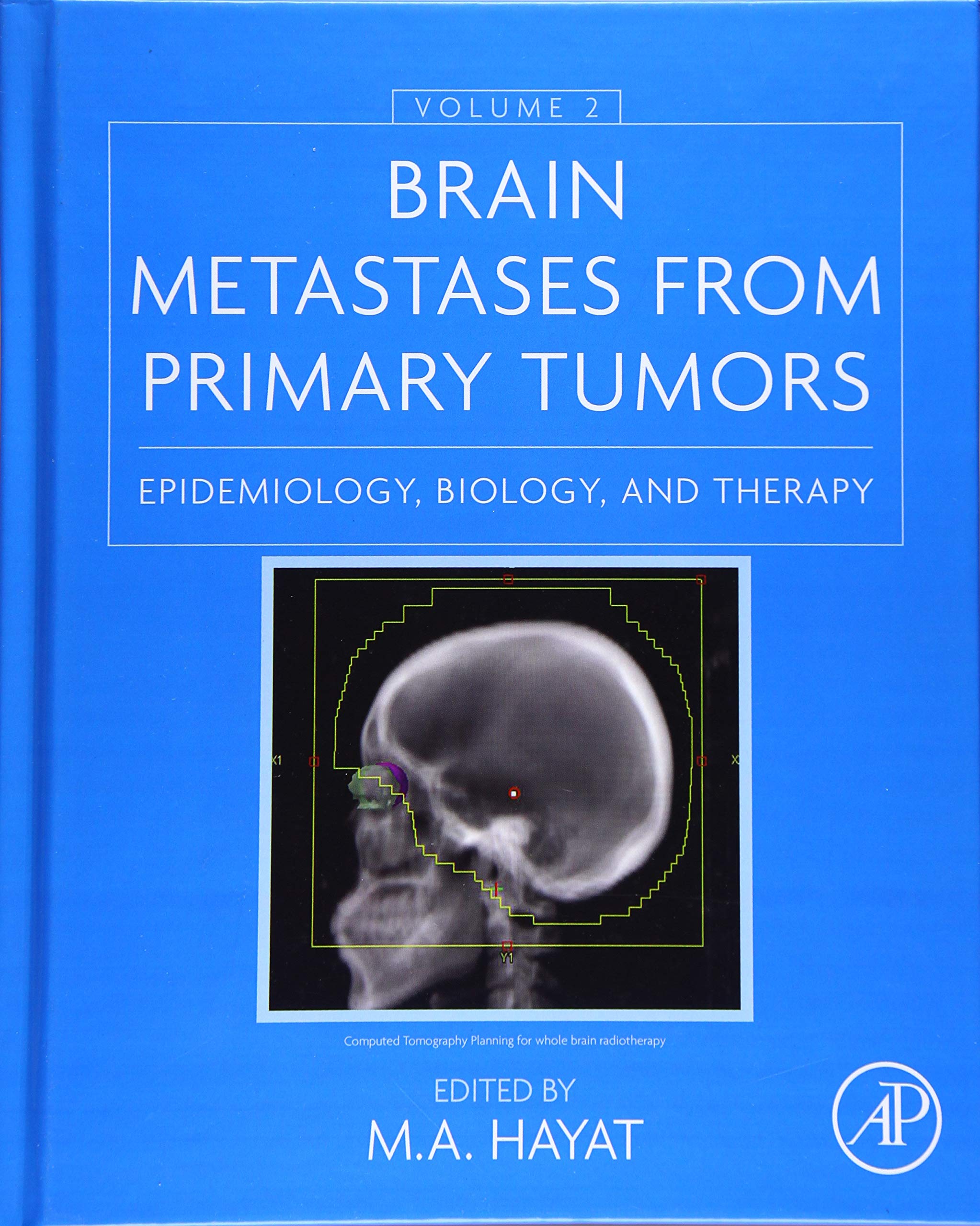 Brain Metastases from Primary Tumors