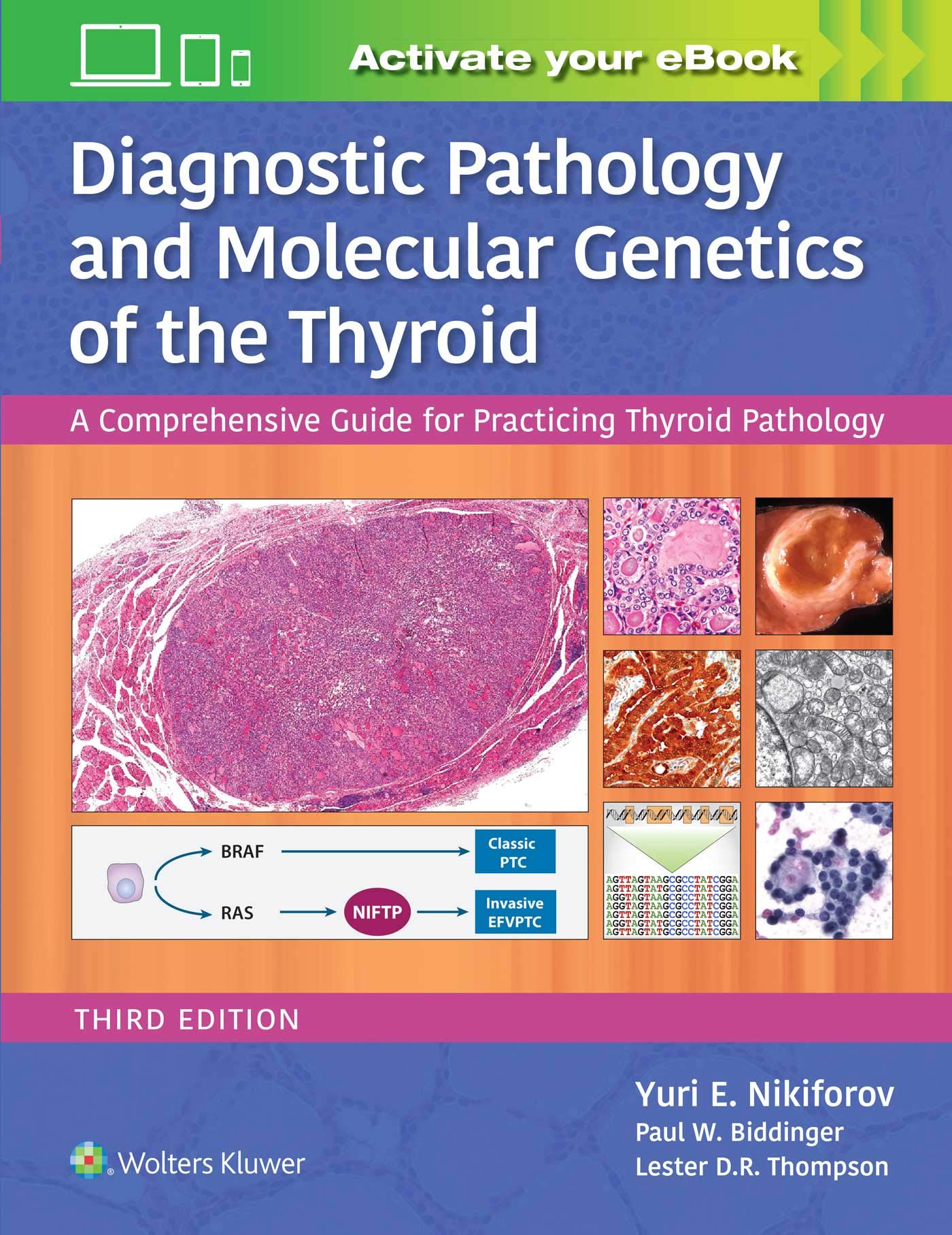 Diagnostic Pathology and Molecular Genetics of the Thyroid: A Comprehensive Guide for Practicing Thyroid Pathology-ISBN: 9781496396532