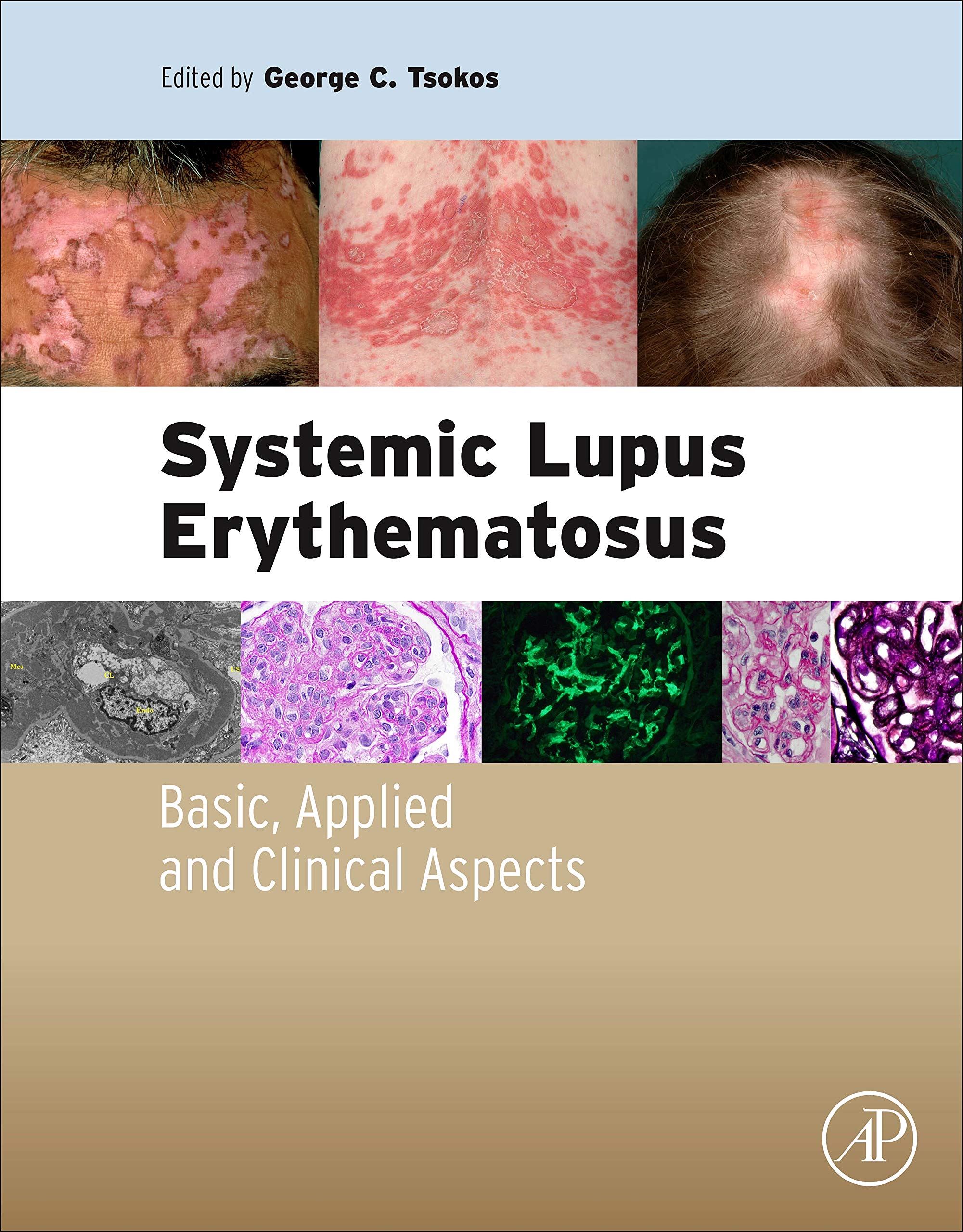 Systemic Lupus Erythematosus: Basic