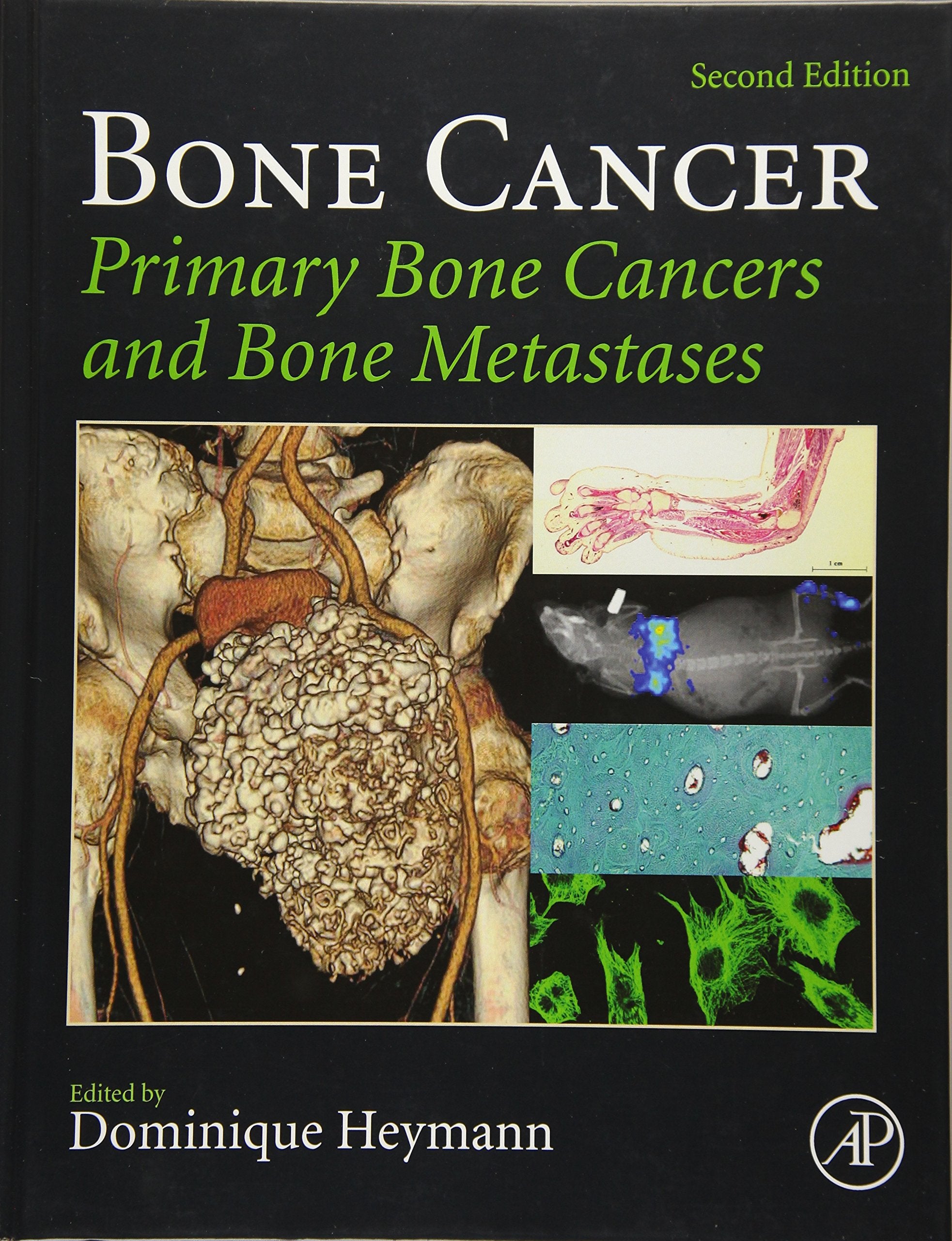 Bone Cancer: Primary Bone Cancers and Bone Metastases